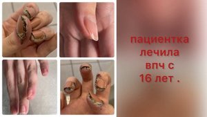Залипательное видео динамик грибка ногтей / Лечение грибка ногтей / ДО и ПОСЛЕ #москва #ногти