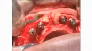 Имплантация  ЗУБОВ В МОСКВЕ (КАЧЕСТВЕННО)