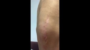 КОНСИЛИУМ: Тендинит трицепса+ периостит локтевого отростка по МРТ. Год назад локтевая бурсэктомия