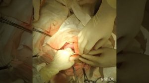 Илеостомия по поводу кишечной непроходимости