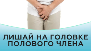 Красный плоский лишай на головке полового члена