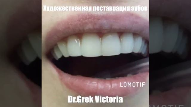 Художественная реставрация зубов
