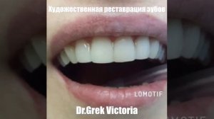 Художественная реставрация зубов