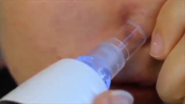 от черных точек в домашних условиях смотреть онлайн