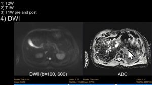Introduction to Liver MRI: Approach and Case-Based Course