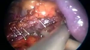 лапароскопическое удаление селезенки Аболмасов А.В.