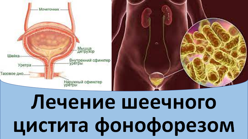 Шеечный цистит у женщин. Лекарство при цистите воспаление мочевого пузыря. Хронический цистит у женщин.