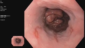 Аксиальная хиатальная грыжа. Эрозивный рефлюкс-эзофагит, ст.В (Лос-Анджелесская классификация).
