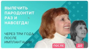Как избавиться от пародонтита раз и навсегда – имплантация всех зубов