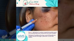 Check out how Bellafill can rid deep acne scarring.