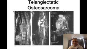 Первичные опухоли позвоночника.