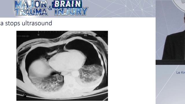 Ultrasonography in trauma (eFAST) Anatole Harrois  ESICM 22 Tr&TBI