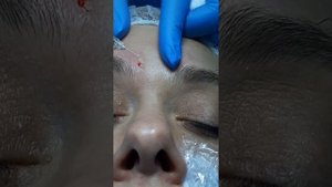 Бланшинг межбровья