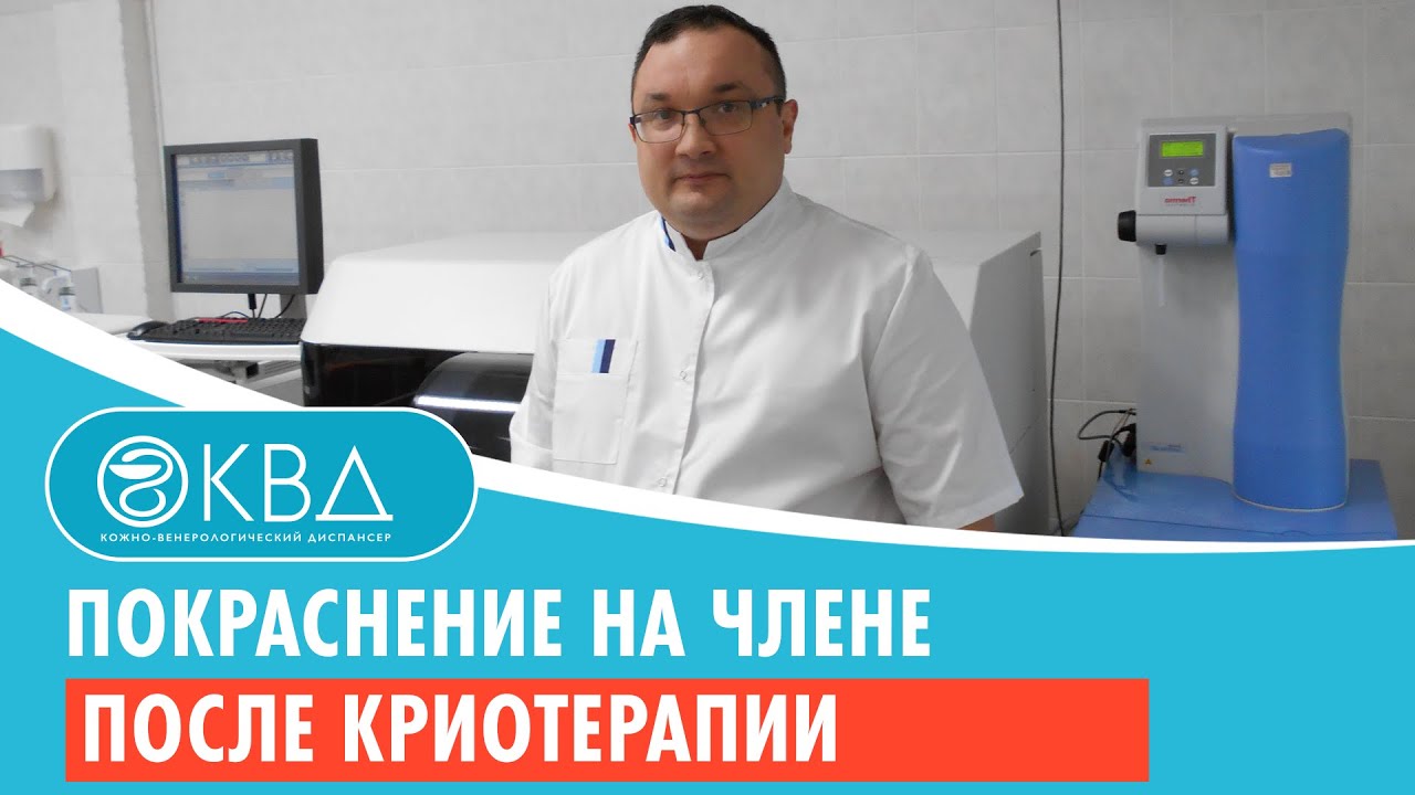 ? Покраснение на члене после криотерапии. Клинический случай №220