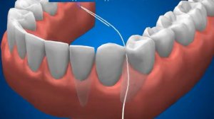 Гигиена промывного пространства под мостовидным протезом