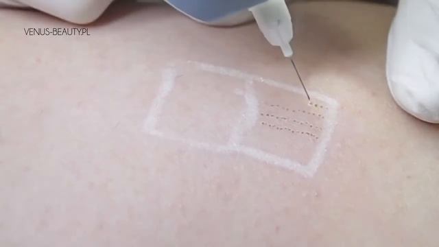 Аппарат для плазменного лифтинга PLASMATIC Skin Healh 2 смотреть онлайн