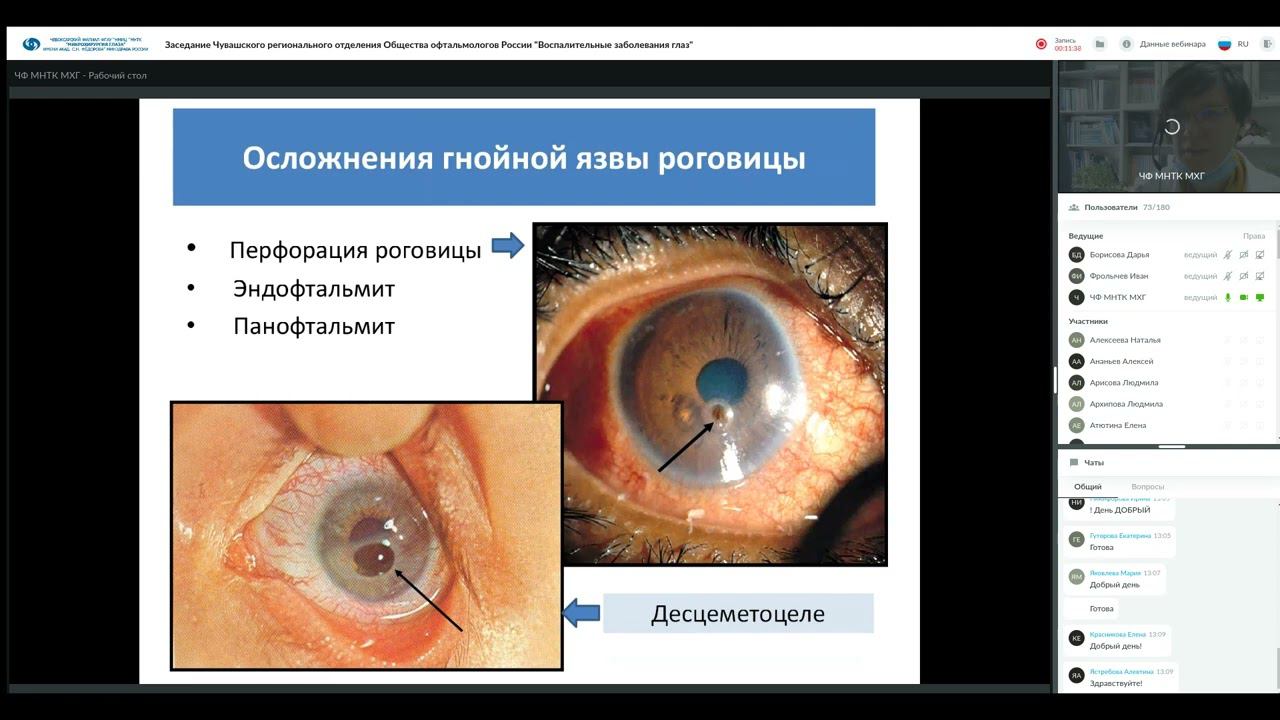 РООР 19 11 21  Воспалительные заболевания глаз