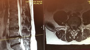 История пациента c грыжей диска позвоночника L4-L5
