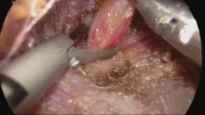 Transoral Endoscopic Thyroidectomy, Dr. Jeremy Richmon, Mass Eye and Ear