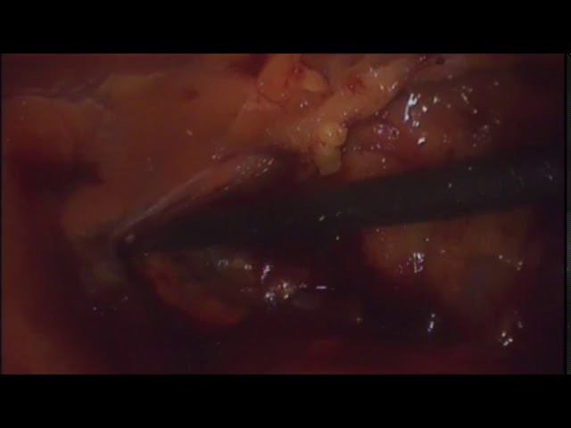 laparoscopic eTEP inguinal hernia смотреть онлайн