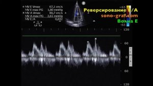 201 - Эхокардиография - Нарушение релаксации левого желудочка