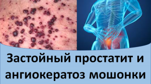 Застойный простатит и ангиокератоз мошонки