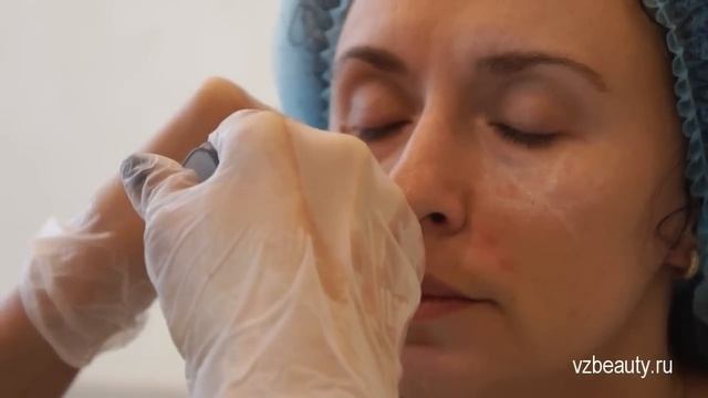 Восполнение объема щек, носогубные складки #4 смотреть онлайн
