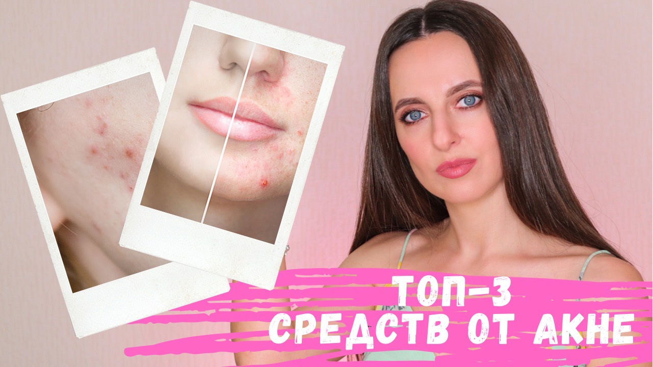 КАК избавиться от ПРЫЩЕЙ | Три СУПЕР средства от АКНЕ смотреть онлайн