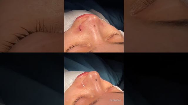 Ринопластика: сужение основания и кончика носа #nosejob