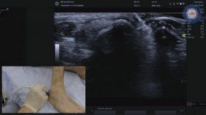 Функциональный тест на нестабильность сухожилий малоберцовых мышц.