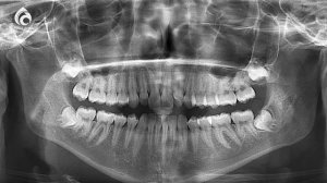 Как правильно лечить перелом челюсти?/Семейный доктор/АСЫЛ АРНА