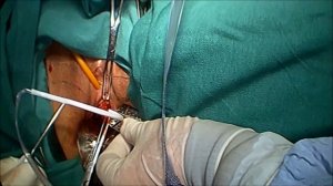 TVT-O Continence Surgery for Stress Urinary Incontinence