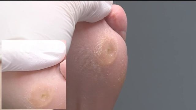 Hohlfräser- Hühneraugen richtig entfernen смотреть онлайн