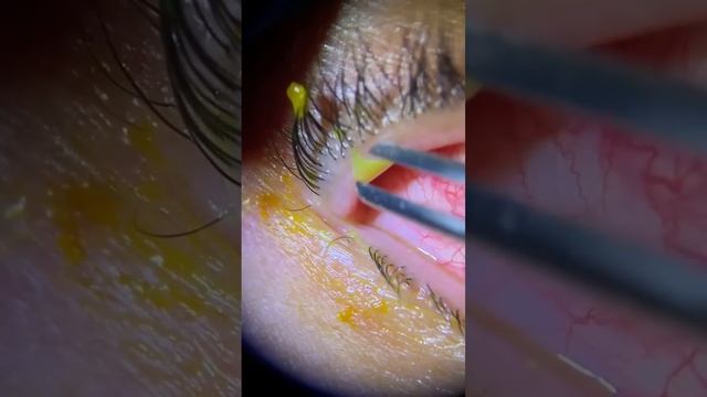 Removal of  A Torn Contact Lens From The Eye.  Has this ever happened to you?