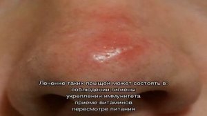 Прыщи на носу: причины у женщин и мужчин. Как избавиться от прыщей на носу за один день?