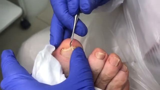 Медицинский педикюр. Обработка ногтей смотреть онлайн