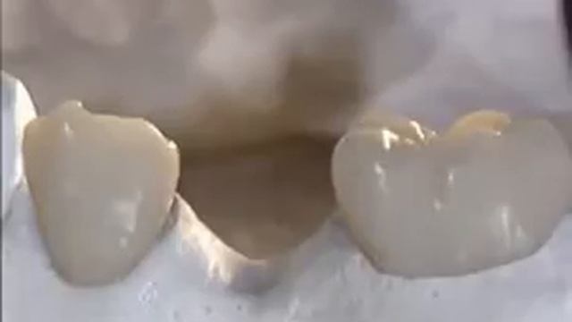 Несъемный протез. Мостовидные протезы смотреть онлайн