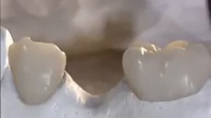 Несъемный протез. Мостовидные протезы