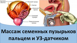 Массаж семенных пузырьков пальцем и УЗ-датчиком