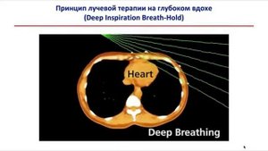 Лучевая терапия рака молочной железы с синхронизацией по дыханию