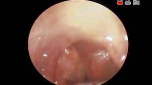 ВИДЕО ЛОР ЭНДОСКОПИЯ ХРОНИЧЕСКИЙ #ДЕКОМПЕНСИРОВАННЫЙ #ТОНЗИЛЛИТ НА ФОНЕ #РЕФЛЮКС ФАРИНГИТА (ГЭРБ)