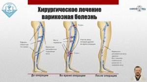 УЗИ сосудов нижних конечностей, Часть 2 / Лайков Алексей Владимирович - врач УЗИ, к.м.н.