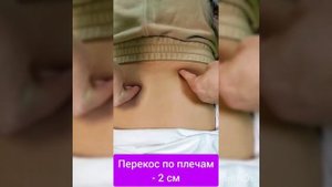 У ребёнка перекос таза 5 см!!! Устранён за одну процедуру!