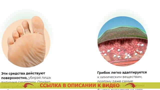 ⚠ Дешевые мази от грибка кожи ног 🔔 Запущенный грибок ногтей на ногах ...