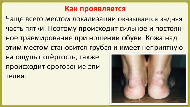 Что такое экзостоз пяточной кости?