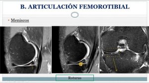 ANATOMÍA IMAGENOLÓGICA DE LA RODILLA