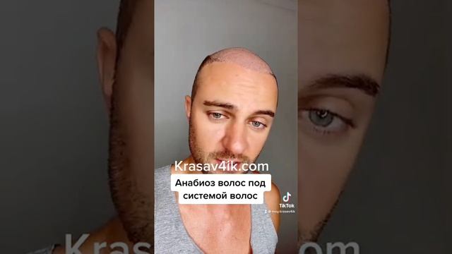 Анабиоз волос под системой. Убивает ли система волосы? #системаволос #красавчик #krasav4ik