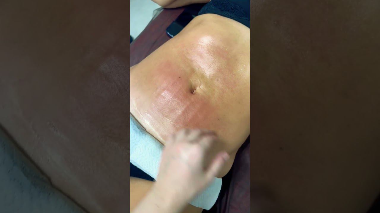 Ручная липосакция живота #shortvideo #массаж #похудение #massage #music #здоровье #shorts  #music