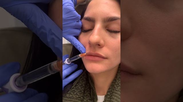 Instagram Winner Juvederm Ultra Plus Lip Injections - Summit NJ, Top NJ Cosmetic Injector Dr. Soni, смотреть онлайн