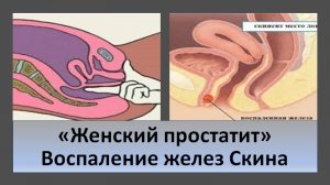 "Простатит" у женщин. Воспаление парауретральных желез Скина.